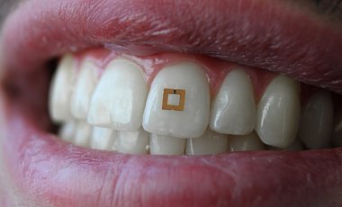 Ученые изобрели мини-датчик на зуб для анализа состава еды